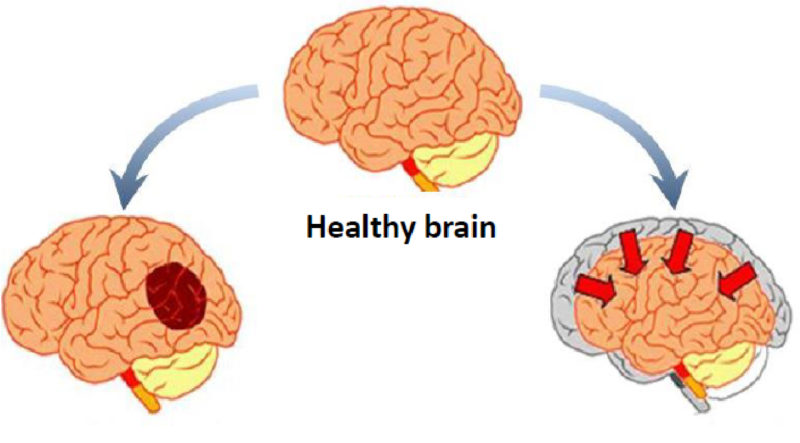 Brain Health – IQL